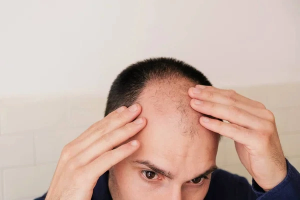 Can PTD-DBM Hair Growth Peptide Stop Balding? 1 PTD-DBM Hair Growth Peptide From Peptide Works