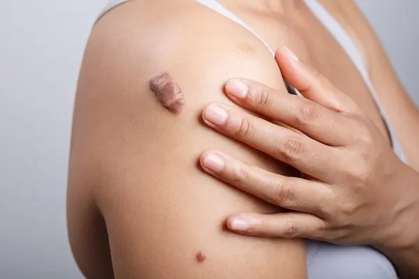 Could FOXO4 be a Keloid Treatment Therapy? 1 Keloid Treatment Therapy
