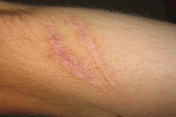 Is Thymalin a Tissue Repair Peptide Therapy?
